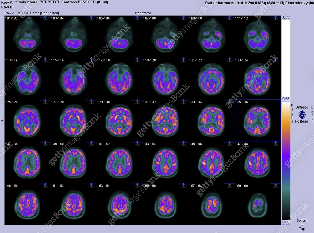 PET-CT axial scan of the brain 이미지 (453449409) - 게티이미지뱅크