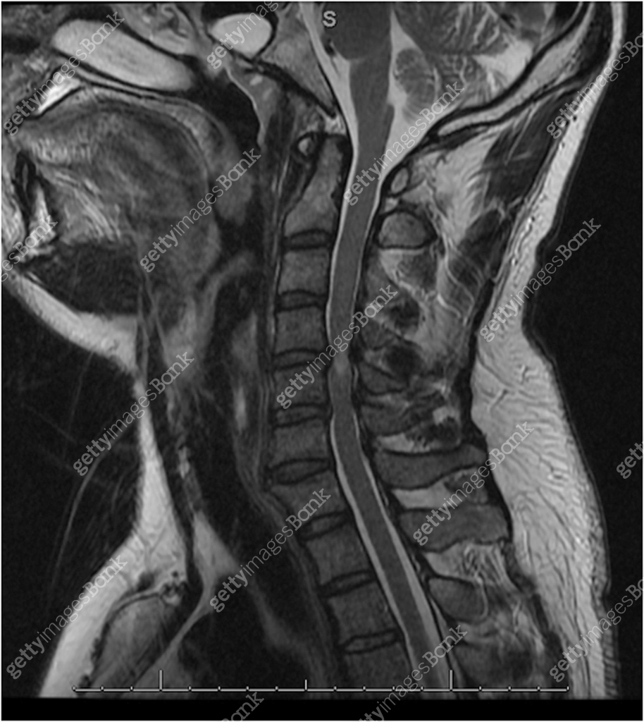 MRI Of Cervical Spinal Canal Stenosis 482300681 mri-of-cervical-spinal-canal-stenosis-482300681