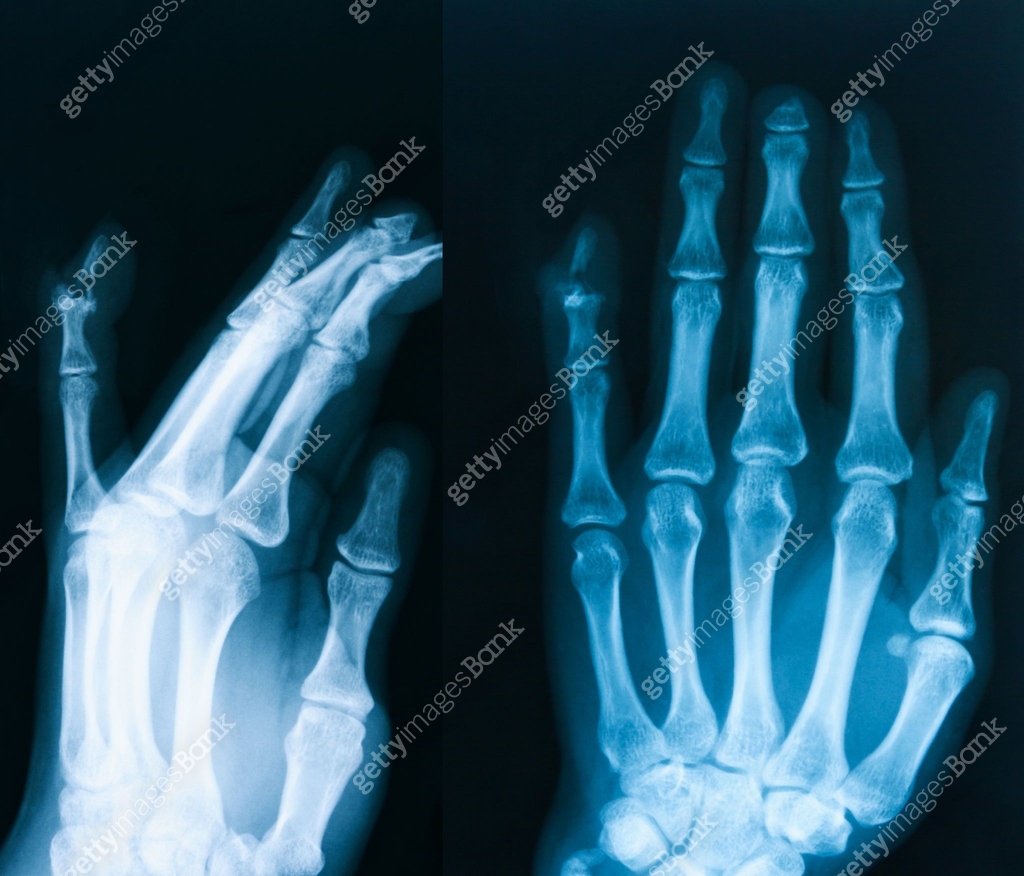X-ray image of hand, AP and oblique view 이미지 (468284402) - 게티이미지뱅크