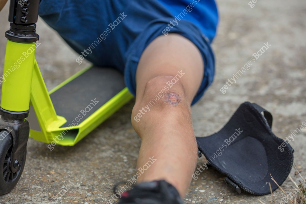 Child with a scraped knee. Boy injured his leg during scooter riding ...