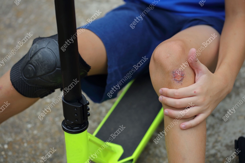 Child with a scraped knee. Boy injured his leg during scooter riding ...