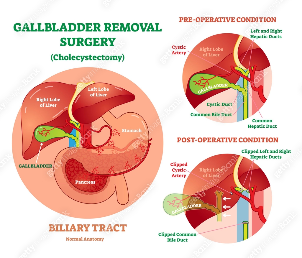 Cholecystectomy Gallbladder Removal Surgery Anatomical Vector cholecystectomy-gallbladder-removal-surgery-anatomical-vector