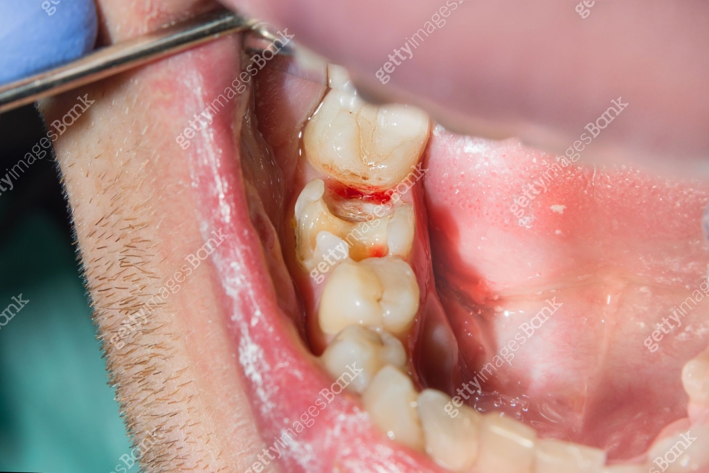 Toot Rotten Inside Dental treatment in dental clinic. Rotten carious tooth macro ...