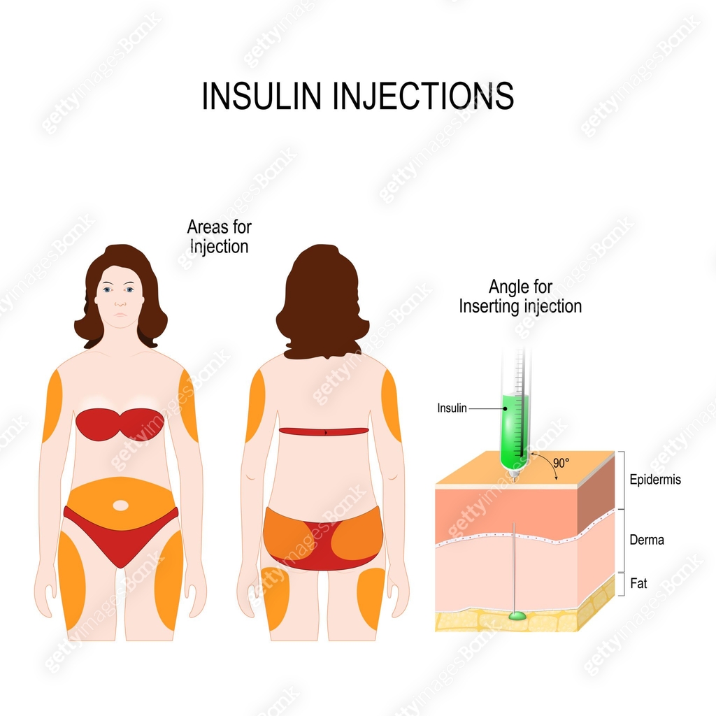 Isulin Injections insulin injections 이미지 (968275182) 일러스트, 무료 일러스트 - 게티이미지뱅크