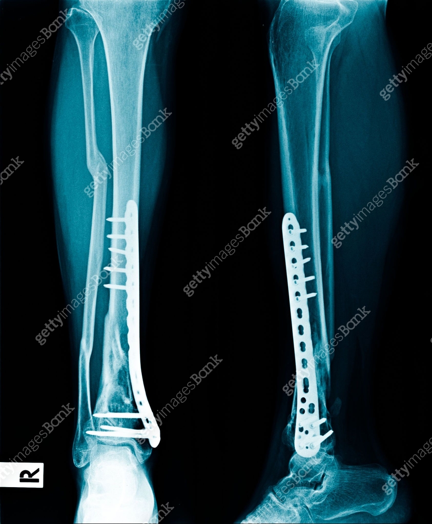 Left Tibia Fixation x-ray internal fixation distal tibia 이미지 (1013502192) - 게티이미지뱅크