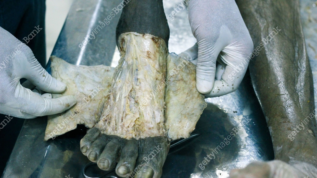 Anatomy dissection of a cadaver showing dorsum of foot using scalpel ...