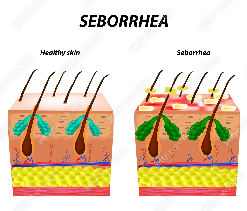 Seborrhea Condition Seborrhea skin and hair. Dandruff seborrheic dermatitis. Eczema ...