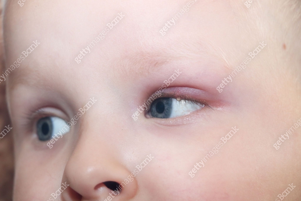 Barley Eye Barley, hordeolum in a child. Purulent pouch on the boy's eye 이미지 ...