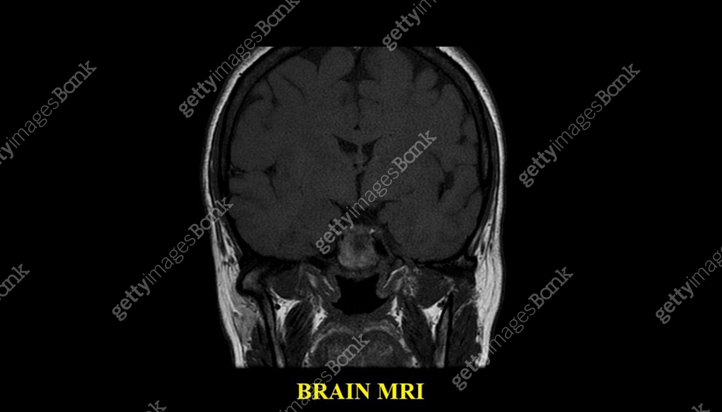 Brain MRI Scan of Healthy Male ( Magnetic Resonance Imaging) High ...