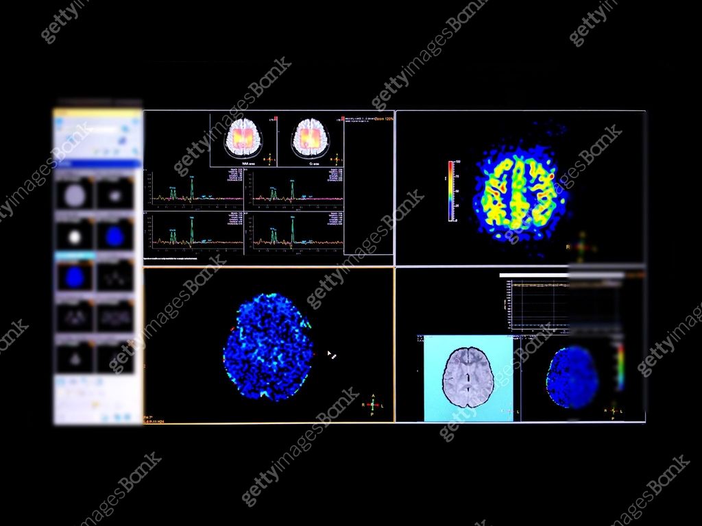 Magnetic Resonance (MR) spectroscopy of the brain for identifies the ...