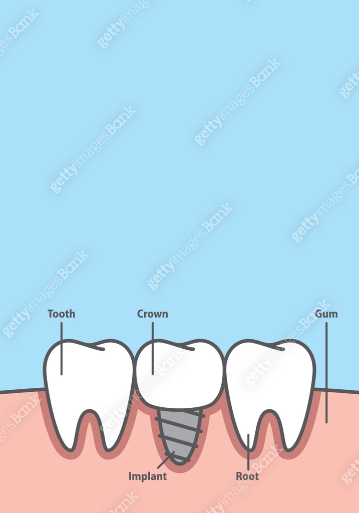 Teeth Frame Blank banner Implant tooth between real teeth frame cartoon style for ...