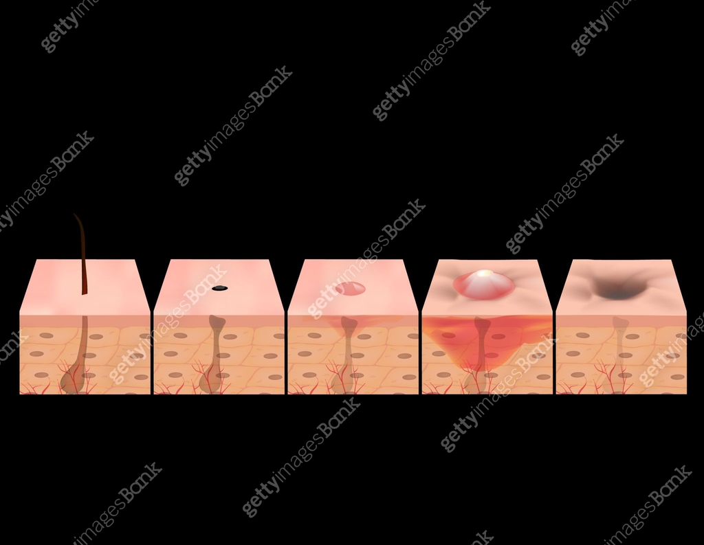 Exploding Cyst Boils Pimples Treatment of open comedones, inflamed acne, acne cysts. Sore acne ...