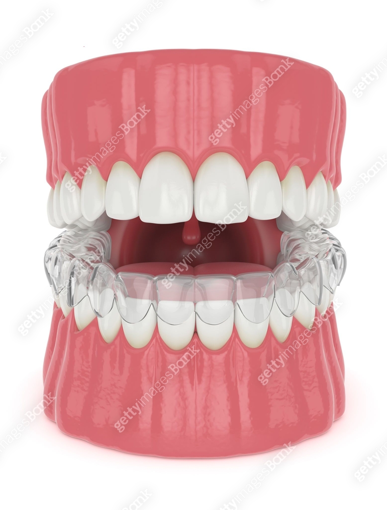 3d render of jaw with invisalign removable retainer 이미지 (1210031998 ...