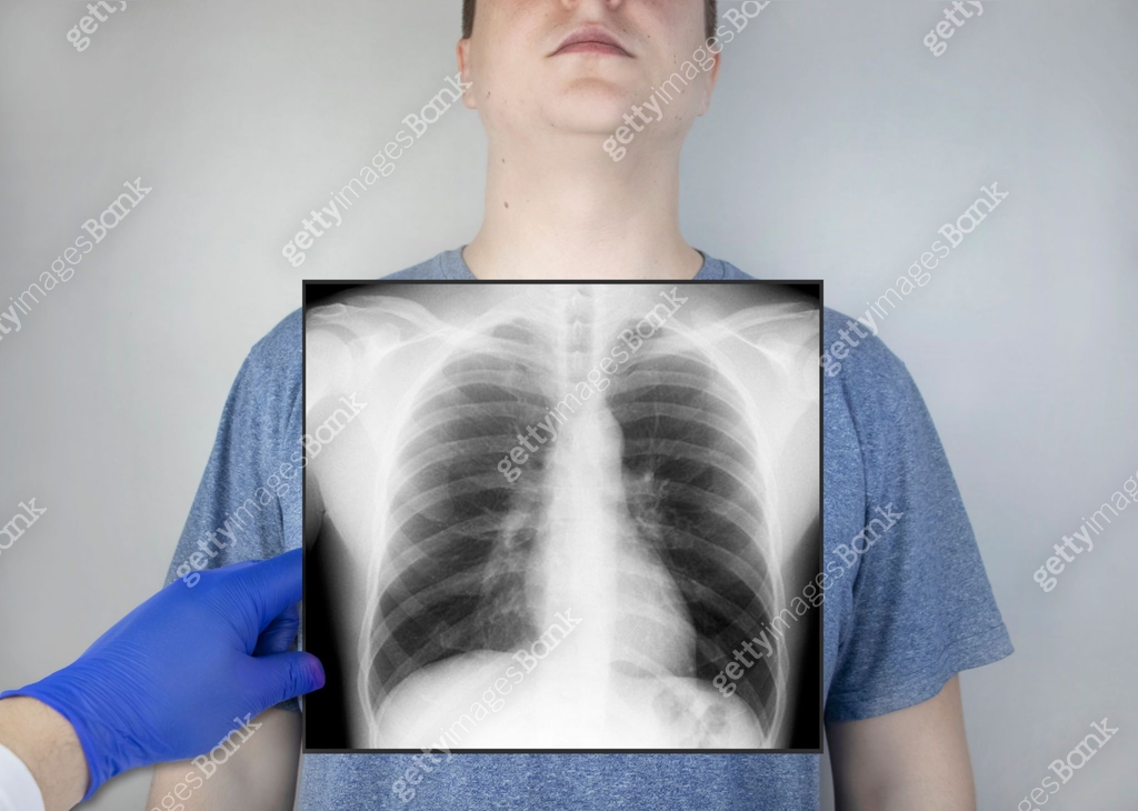 X-ray of the chest of a man. A doctor radiologist is studying an x-ray ...