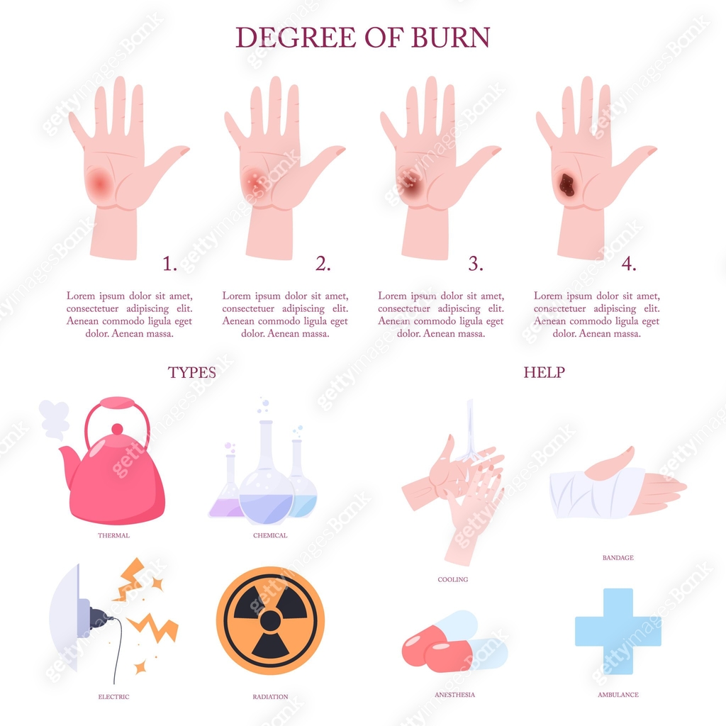 Skin Injury Graphical Abstract Skin burn injury treatment and stages infographic. 이미지 (1257185516 ...