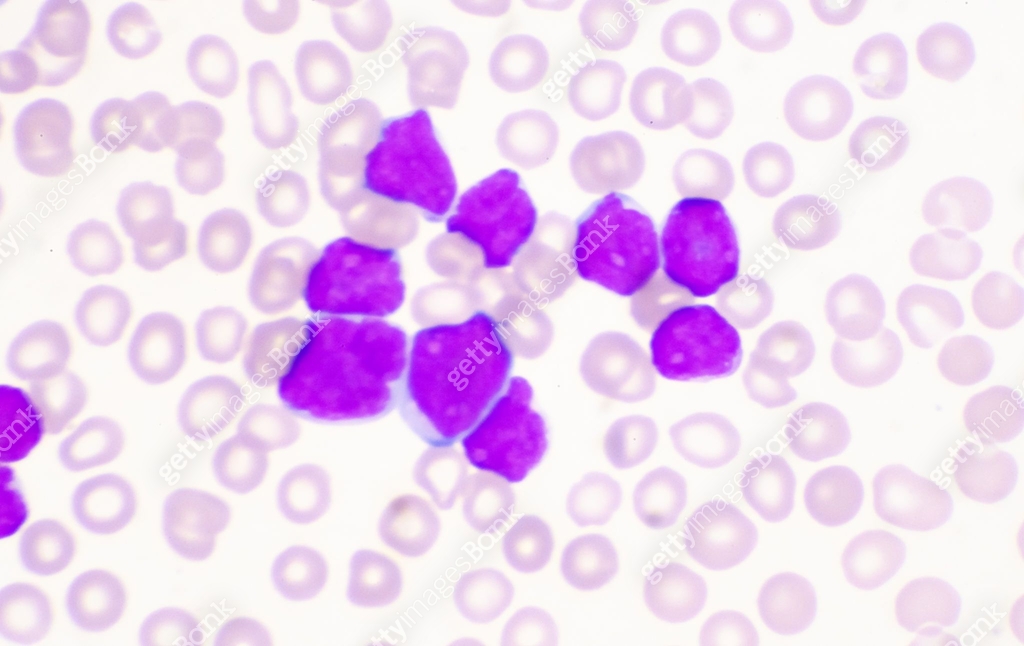 Moderate blast cell of white blood cells in blood smear.Leukemia blood ...