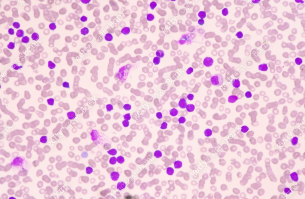 Moderate blast cell of white blood cells in blood smear.Leukemia blood ...