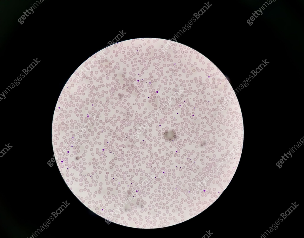 Hematological, CBC blood film microscopic show leucocytopenia. No white ...