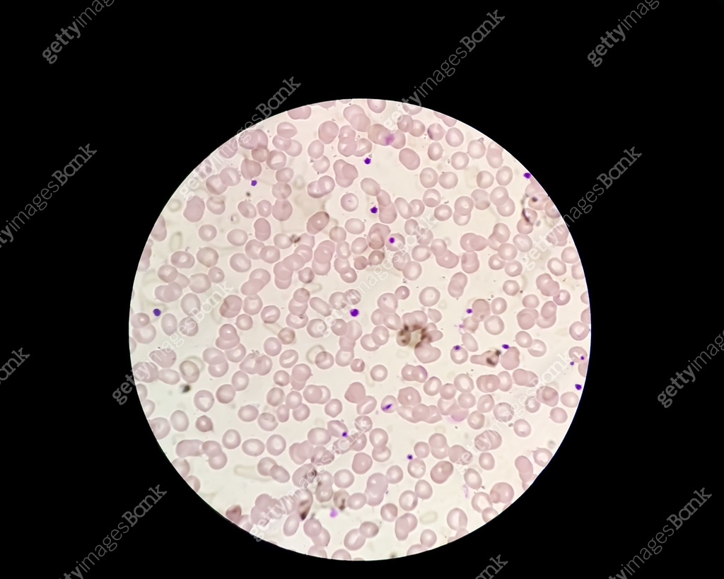 Hematological, CBC blood film microscopic show leucocytopenia. No white ...