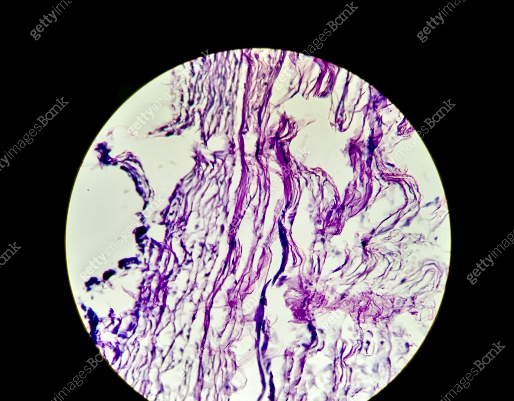 Capillary Microscope Views Lobular Capillary hemangioma, light micrograph, photo under microscope ...