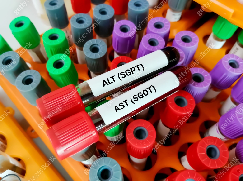 Blood sample for ALT and AST test. Liver function test. 이미지 (1338111031 ...