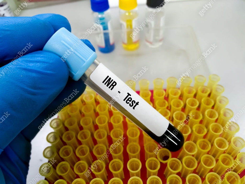 Blood sample for PT, INR test (Blood coagulation testing) 이미지 ...
