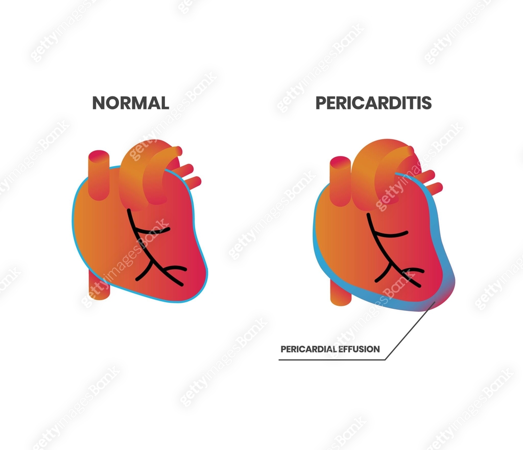 Normal heart anatomy vs pericarditis vector illustration 이미지 ...