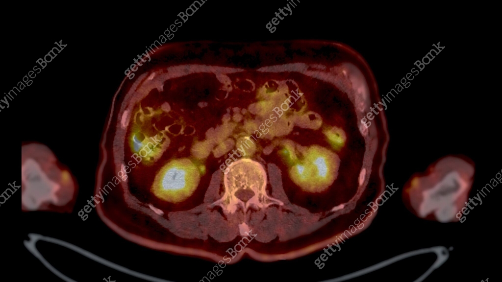 PET CT Scan fusion image It provides detailed images by merging 이미지 ...