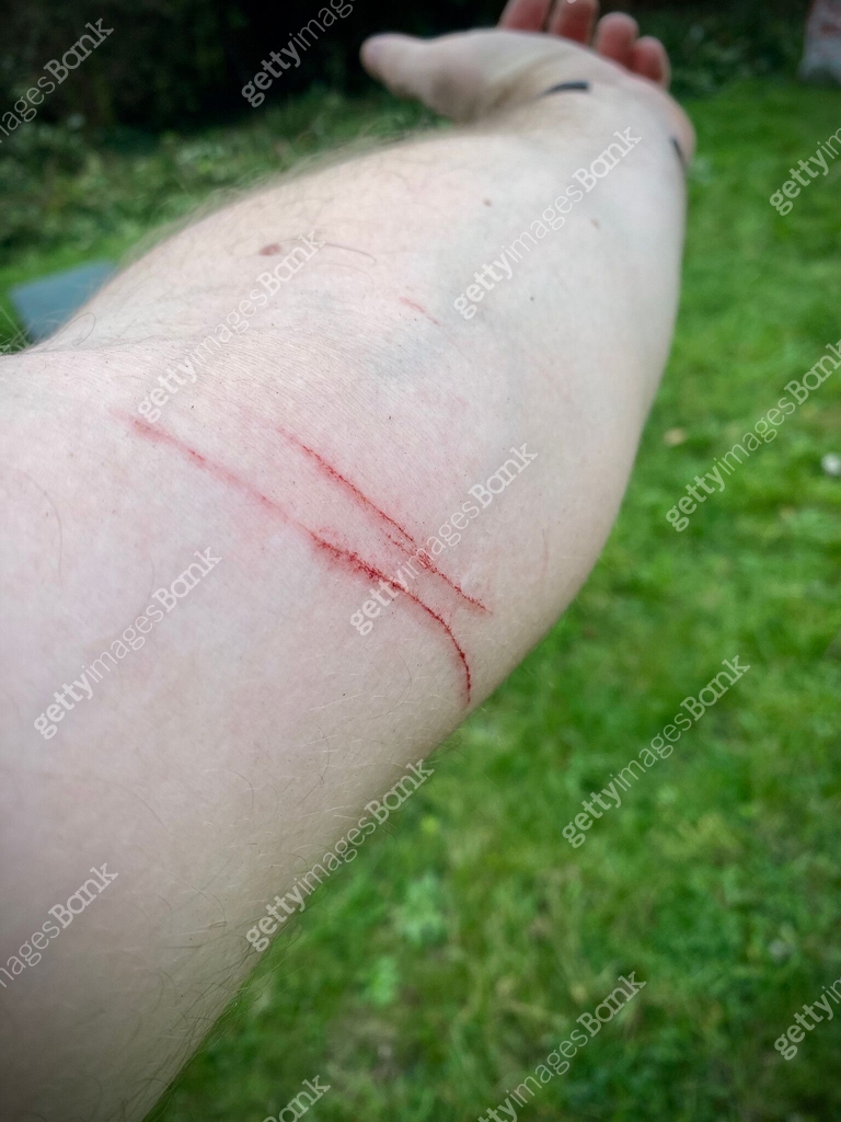 Large scratch/cut on arm from brambles in garden. 이미지 (1728425497) - 게티 ...