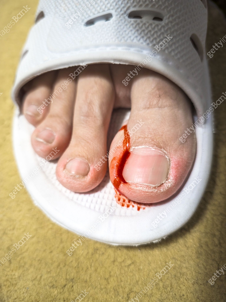 Bleeding Ripped Skin bleeding toe caused by a torn hangnail 이미지 (2187131537) - 게티이미지뱅크