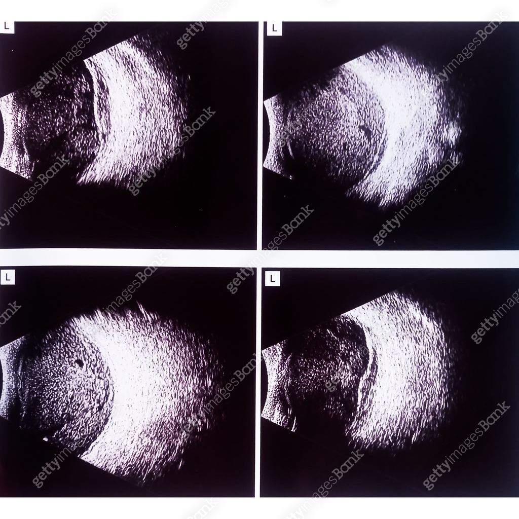 Shadow Scan B-scan ultrasonography (USG). High intensity membranous echogenic ...