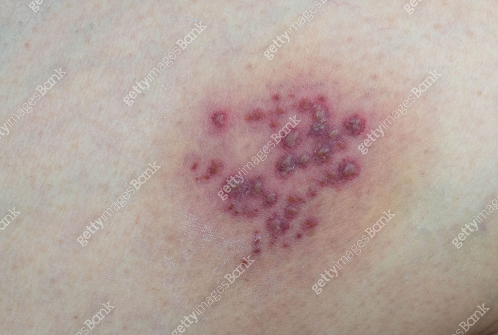 Herpes zoster (shingles) rash on skin, showing red, blistering lHerpes ...