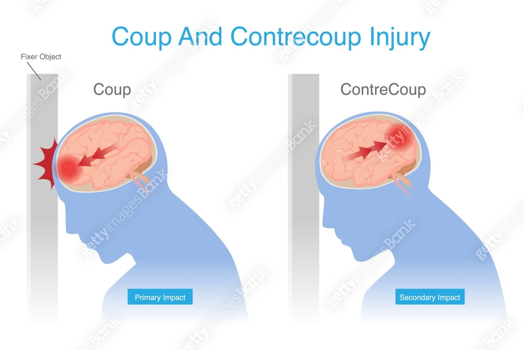 Contrecoup and Coup Injury is brain injury after head strikes an object ...