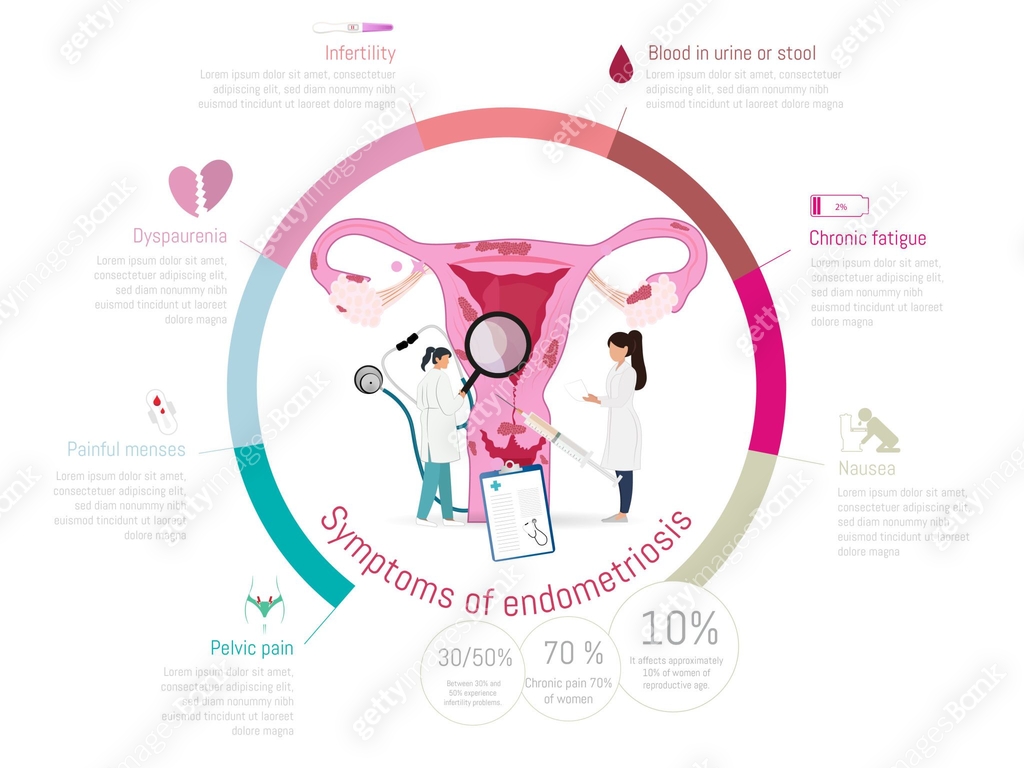 Endometrit Medical illustration highlighting endometriosis symptoms 이미지 ...