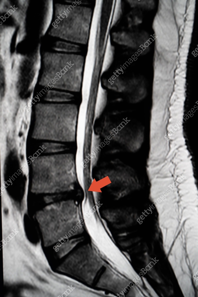 Lateral Scan MRI scan of lateral lumbar vertebral column showing L4-L5 disc ...