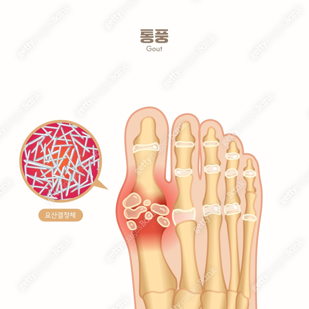정형외과 (건강관리), 질병 (건강이상), 사람뼈 (Body Part), 의학 (과학), 사람발가락 (주요신체부분), 지골 ...
