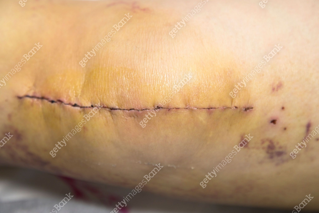 Scar Prothesis Patient month after surgery, long scar on knee Control of healing ...