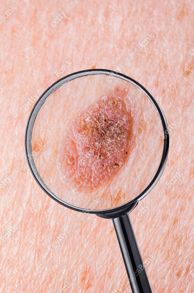 Skin Mole Defect High Magnification Macro Photo for Medical Diagnosis ...