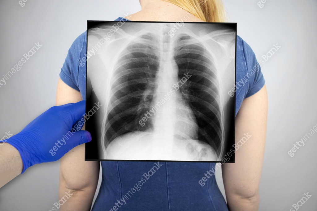 X-ray of the chest of a woman. A doctor radiologist is studying an x ...