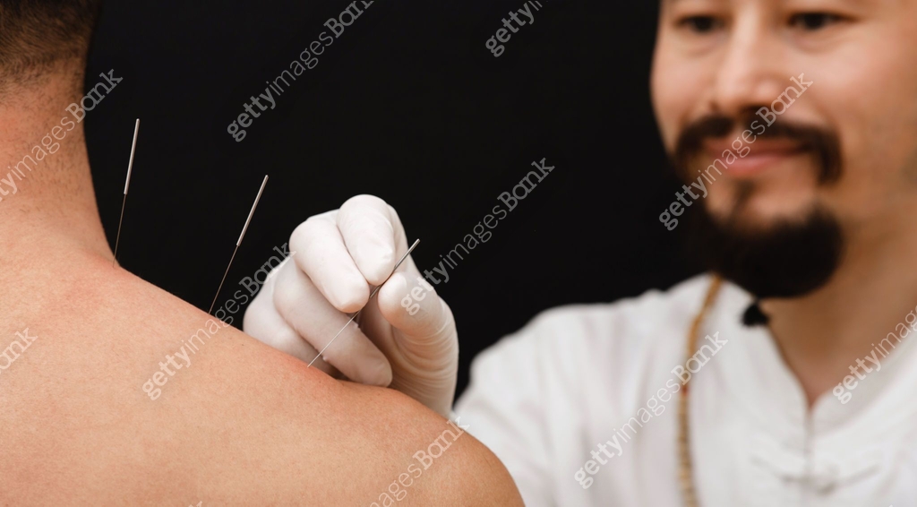 Acupuncture Example Asian acupuncturist doing acupuncture back to relieve man's shoulder ...