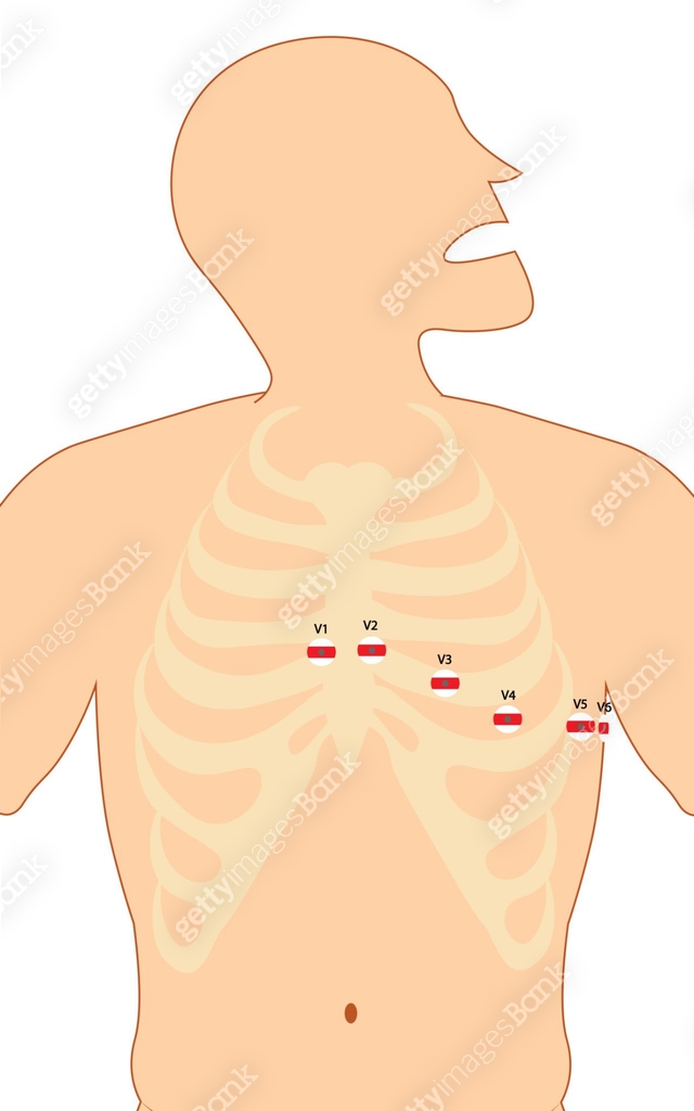 ECG (Electrocardiography) 12-lead Precordial lead placement 이미지 ...