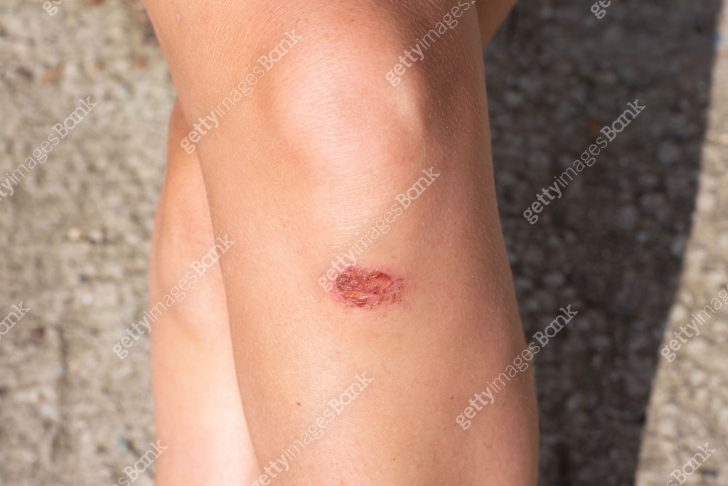 Beautiful female legs with a broken bleeding knee. First aid for falls ...