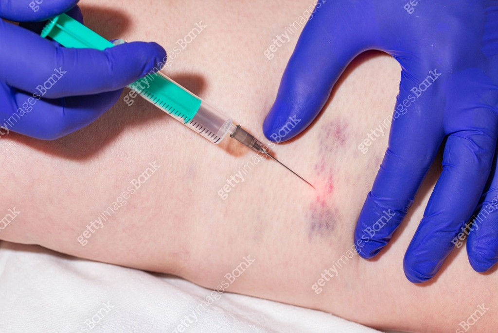 Doctor makes sclerotherapy injection into patient's damaged veins ...