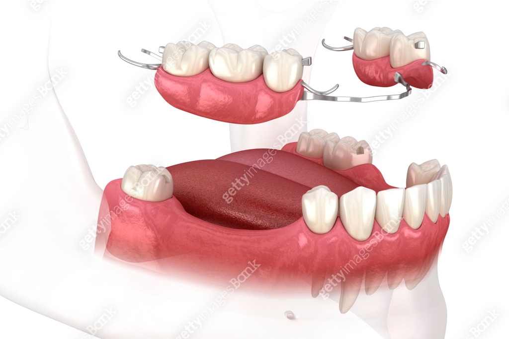 Removable partial denture, mandibular prosthesis. Medically accurate 3D ...