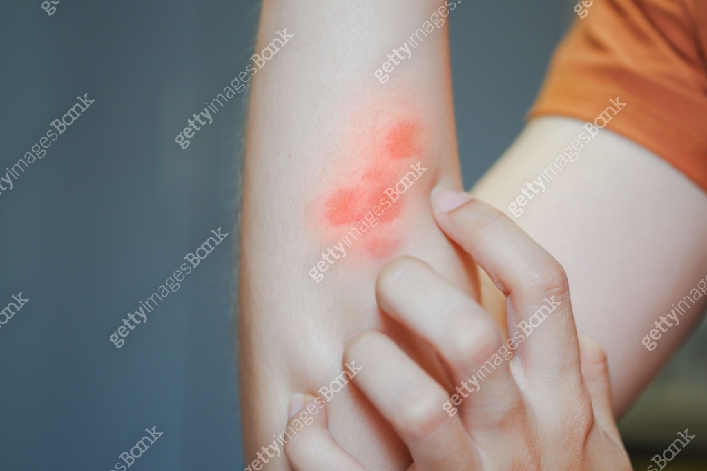 Arm Put Rash The woman's arm scratched with a red rash because of an allergic ...