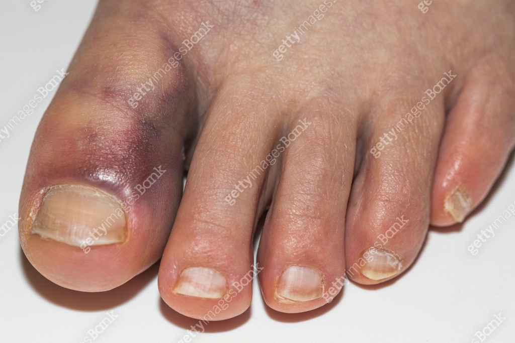 Close up view of man with damaged foot with bruise big toe. Injuries ...