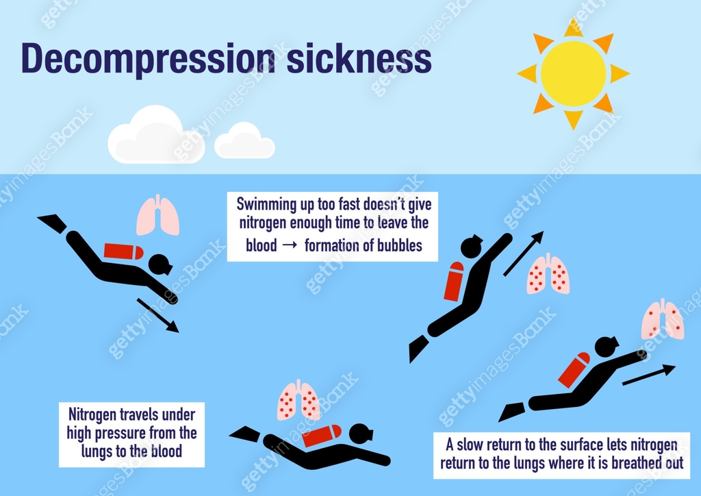 Decompression Sickness Computer The decompression sickness explained 이미지 (1385532851) 일러스트, 무료 일러스트 ...