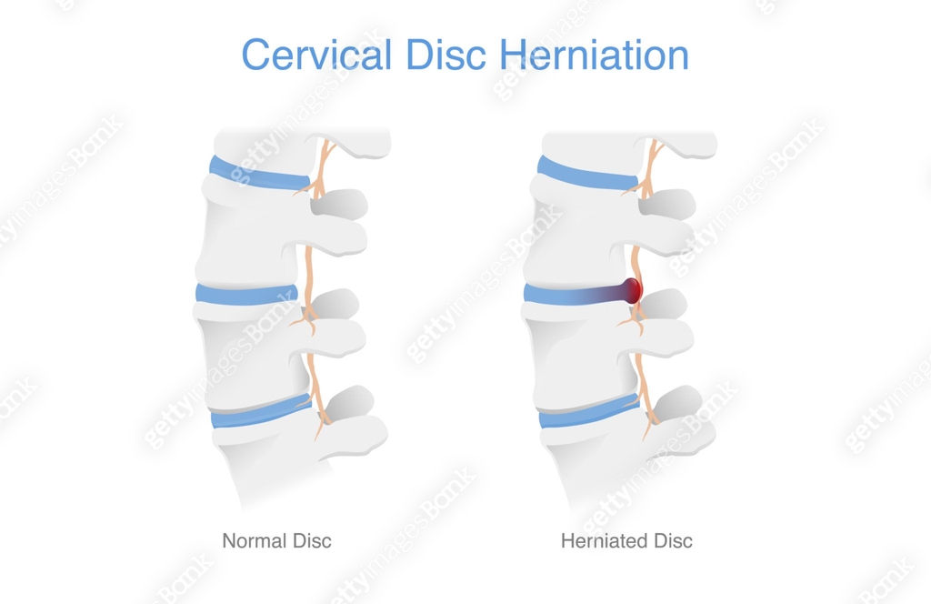 Normal Disc Color Comparing normal cervical disc and disc herniated of the patient ...