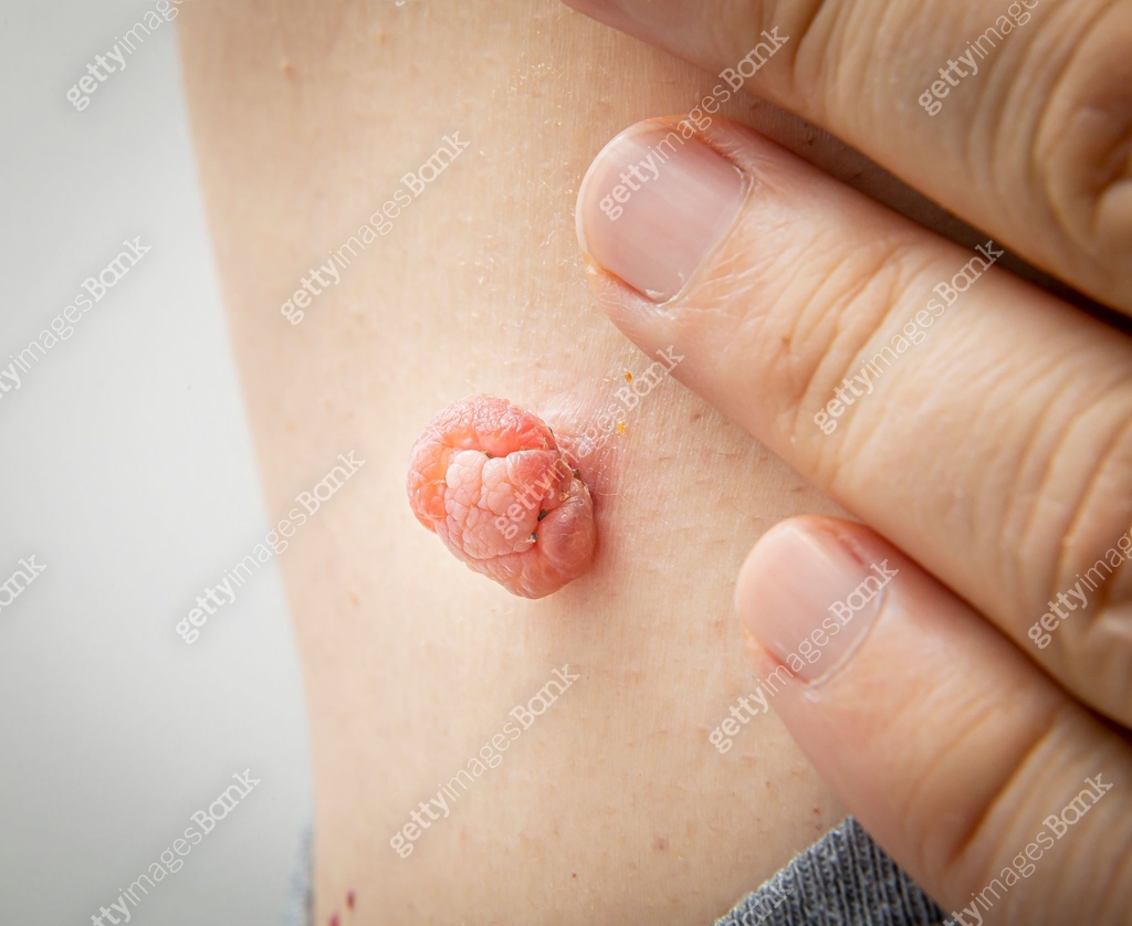Kin Tag Liquid Nitro Skin tag mole treated with liquid nitrogen 이미지 (1401585490) - 게티이미지뱅크