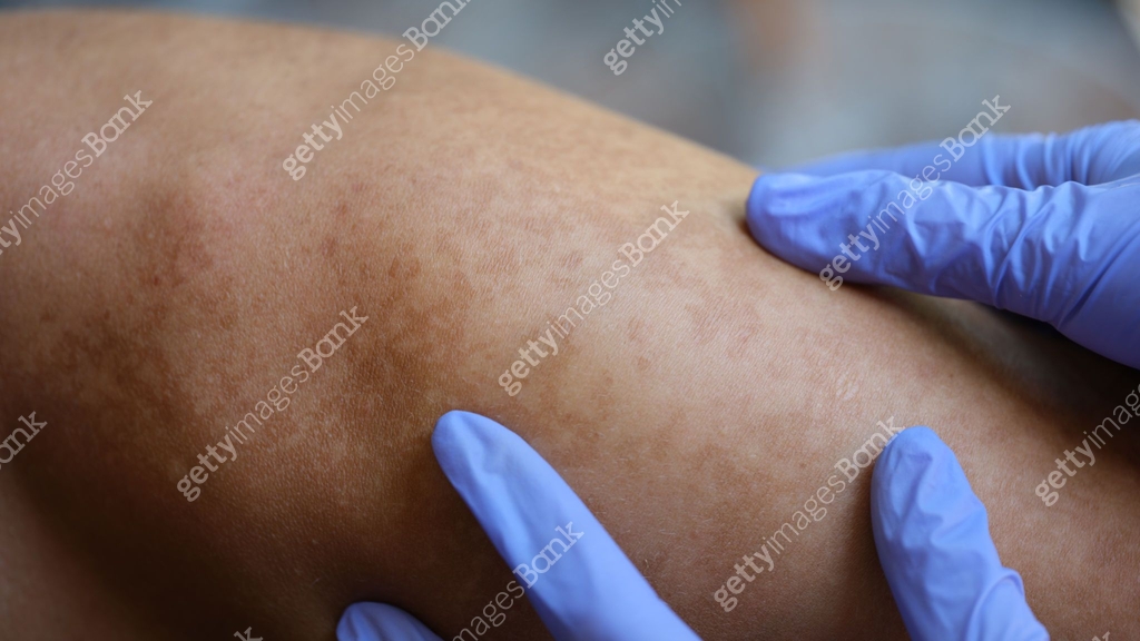 Rubar Skin Doctor hands in rubber protective gloves check skin of young man with ...